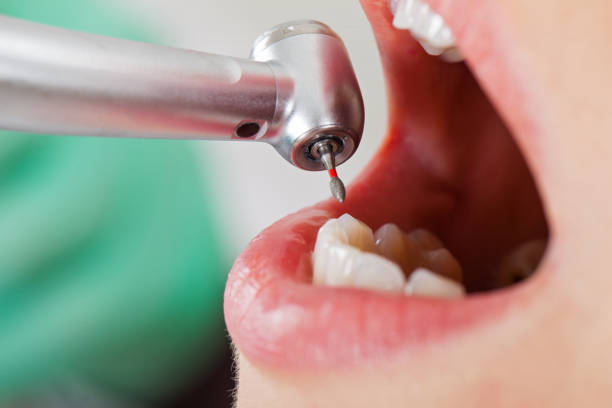 Best Emergency Root Canal Treatment in Fountain Valley, CA
